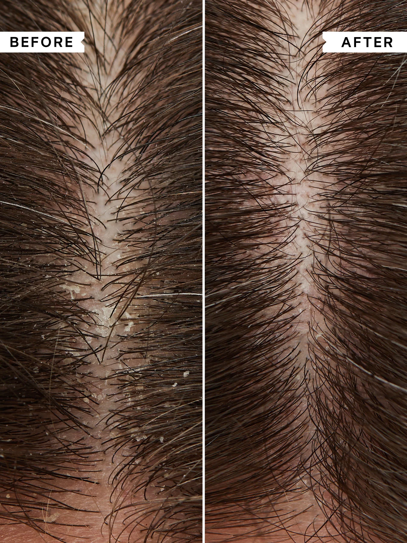 FlakyItchy Scalp Anti-Dandruff Shampoo 75 ml - Image 2